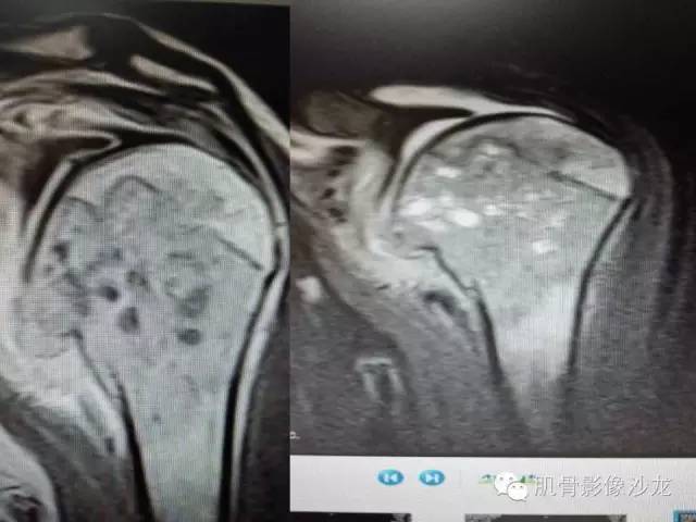 【病例】软骨母细胞瘤合并ABC一例X线及MR影像表现