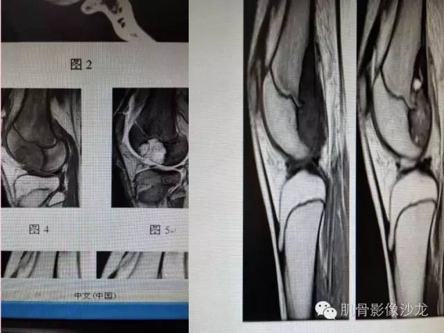 【病例】软骨母细胞瘤合并ABC一例X线及MR影像表现