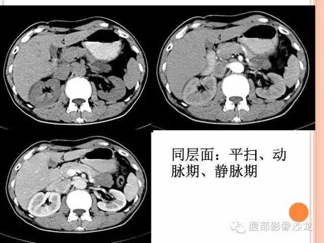 【病例】胰体尾实性假乳头状瘤1例CT影像表现 【病例】胰体尾实性假乳头状瘤1例CT影像表现