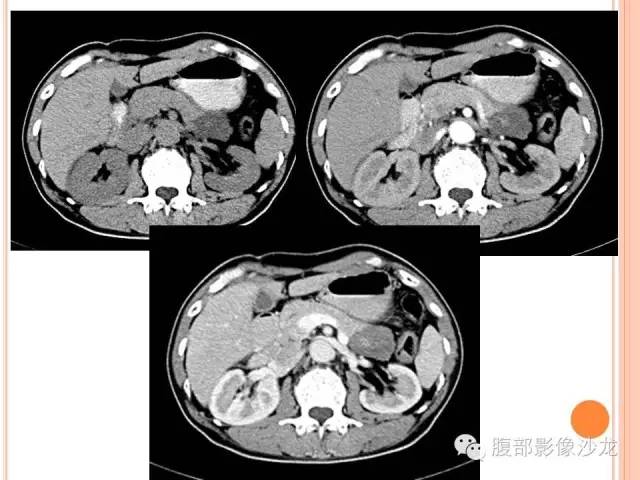 【病例】胰体尾实性假乳头状瘤1例CT影像表现 【病例】胰体尾实性假乳头状瘤1例CT影像表现