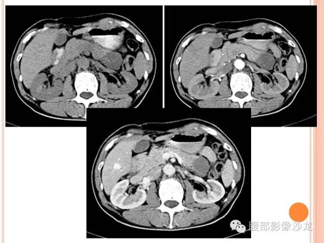 【病例】胰体尾实性假乳头状瘤1例CT影像表现 【病例】胰体尾实性假乳头状瘤1例CT影像表现