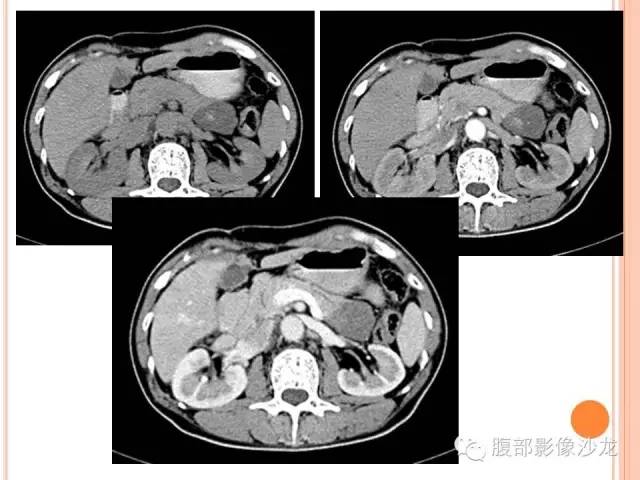 【病例】胰体尾实性假乳头状瘤1例CT影像表现 【病例】胰体尾实性假乳头状瘤1例CT影像表现