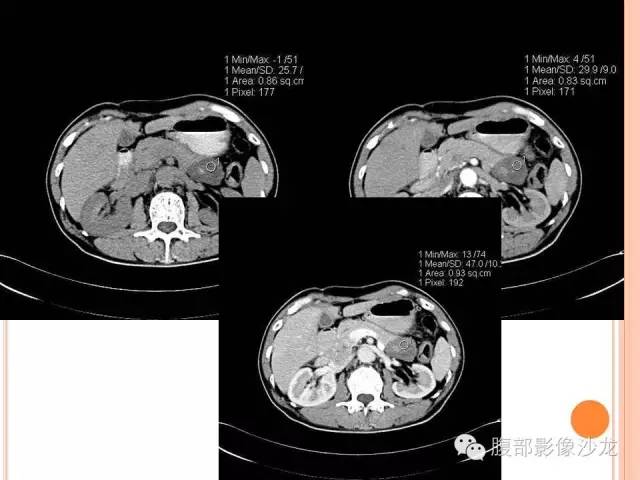 【病例】胰体尾实性假乳头状瘤1例CT影像表现 【病例】胰体尾实性假乳头状瘤1例CT影像表现