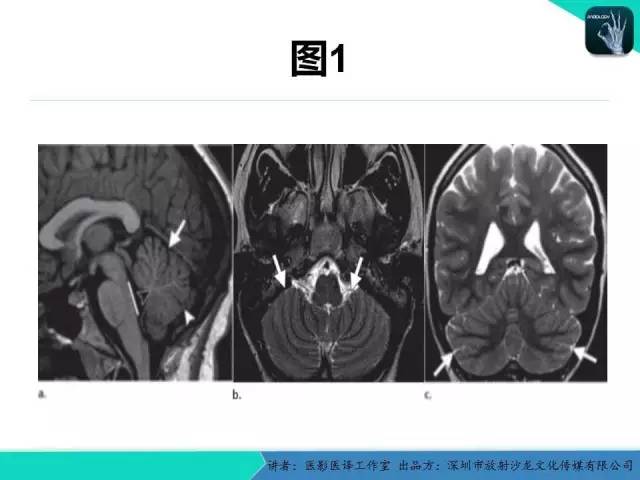 【PPT】后颅窝异常的神经影像学表现