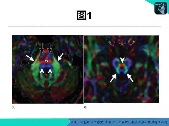 【PPT】后颅窝异常的神经影像学表现