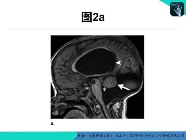 【PPT】后颅窝异常的神经影像学表现