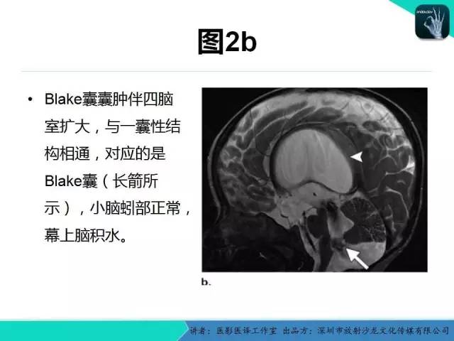 【PPT】后颅窝异常的神经影像学表现