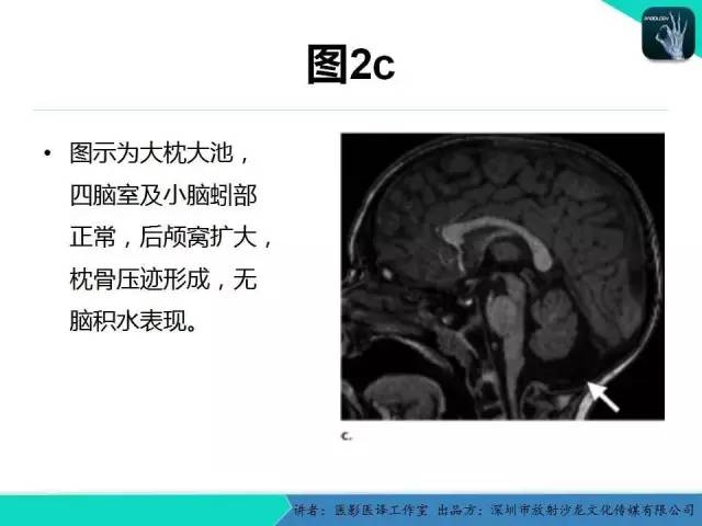 【PPT】后颅窝异常的神经影像学表现