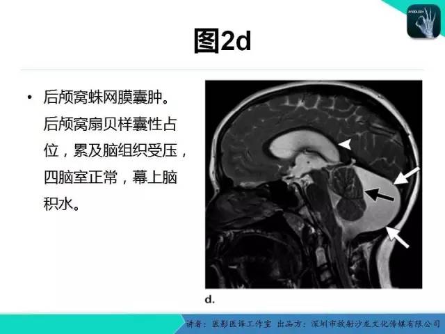 【PPT】后颅窝异常的神经影像学表现