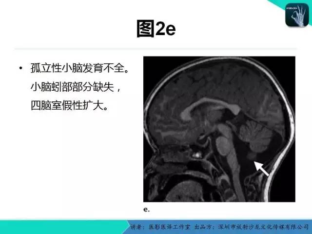 【PPT】后颅窝异常的神经影像学表现