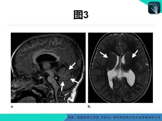 【PPT】后颅窝异常的神经影像学表现