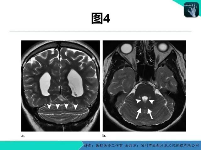 【PPT】后颅窝异常的神经影像学表现