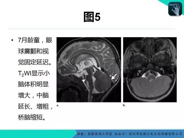【PPT】后颅窝异常的神经影像学表现