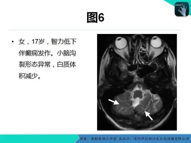【PPT】后颅窝异常的神经影像学表现