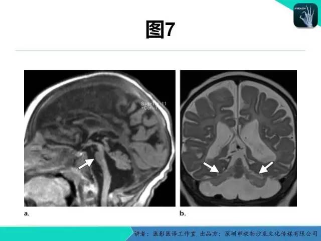 【PPT】后颅窝异常的神经影像学表现