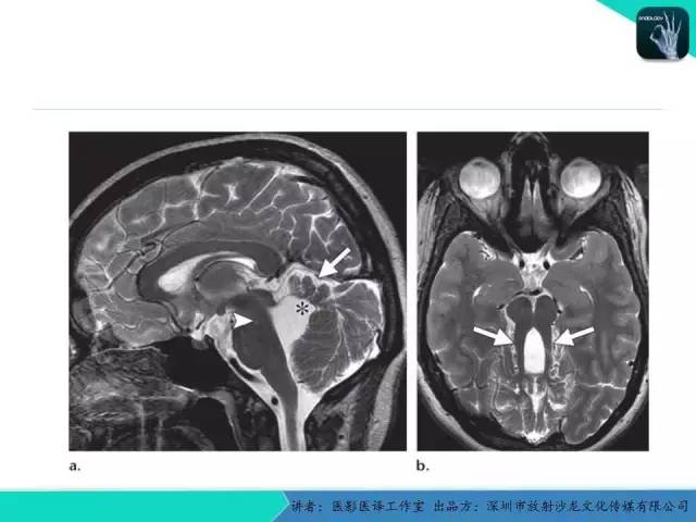 【PPT】后颅窝异常的神经影像学表现