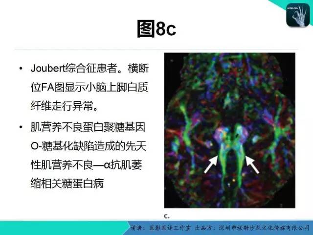 【PPT】后颅窝异常的神经影像学表现