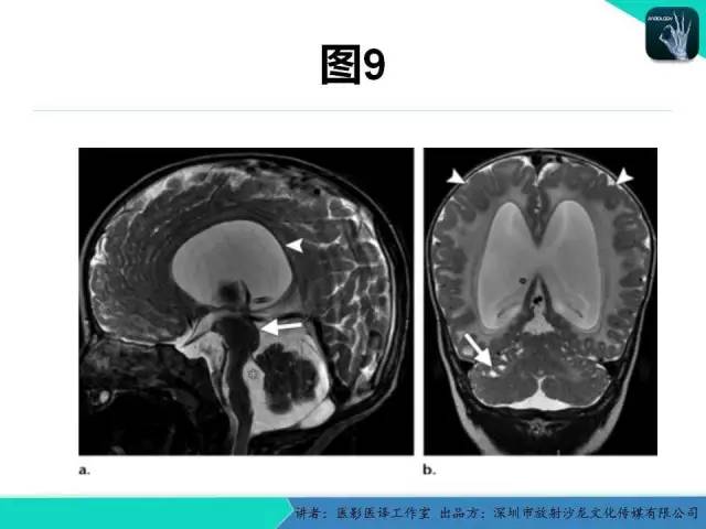 【PPT】后颅窝异常的神经影像学表现