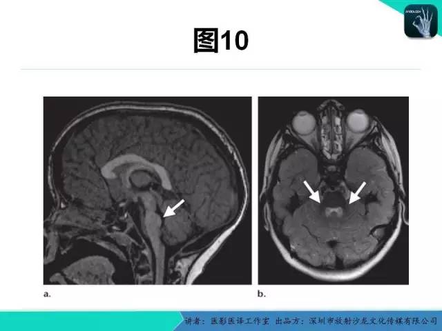 【PPT】后颅窝异常的神经影像学表现