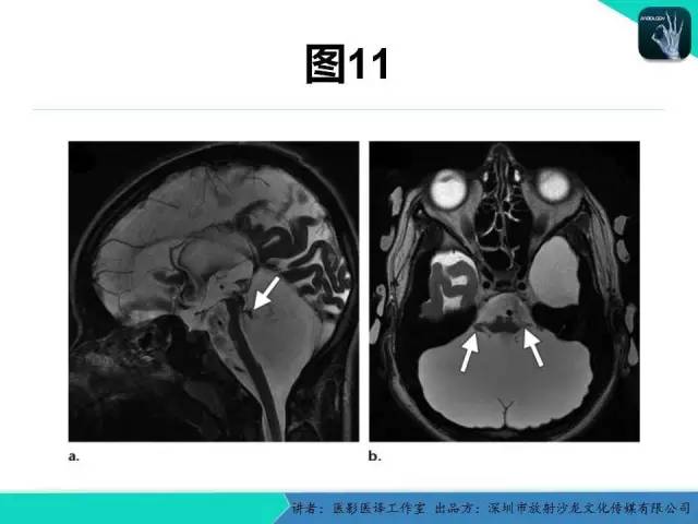 【PPT】后颅窝异常的神经影像学表现