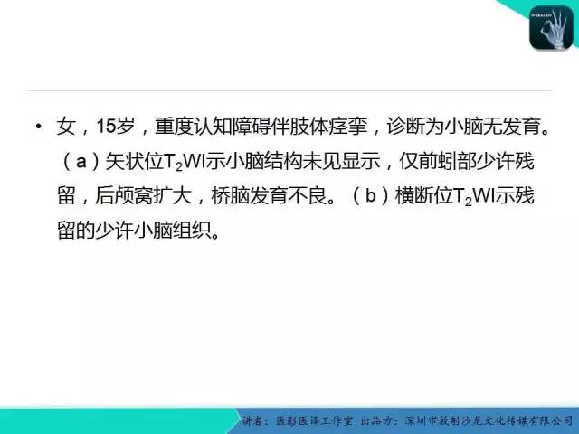 【PPT】后颅窝异常的神经影像学表现