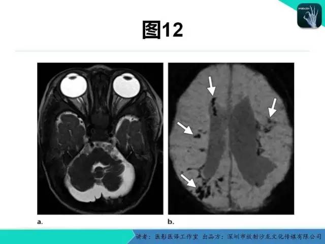 【PPT】后颅窝异常的神经影像学表现