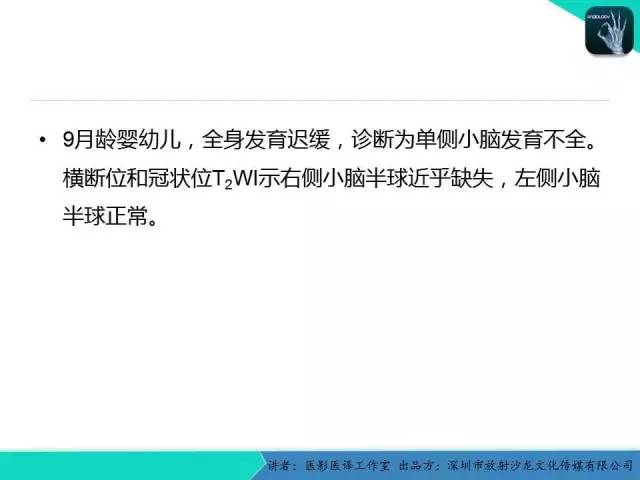 【PPT】后颅窝异常的神经影像学表现