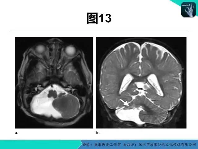 【PPT】后颅窝异常的神经影像学表现