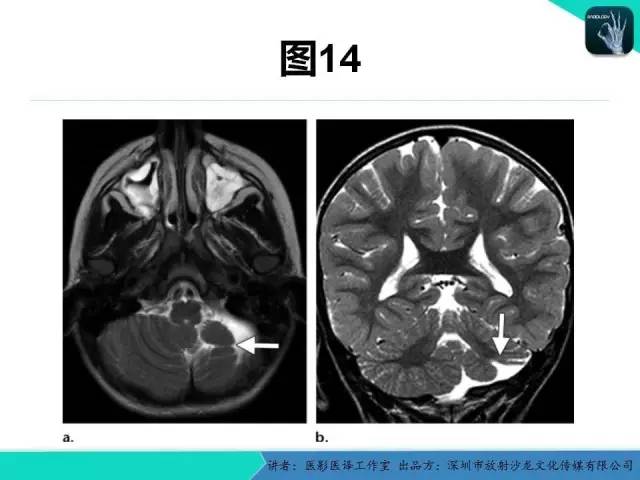 【PPT】后颅窝异常的神经影像学表现