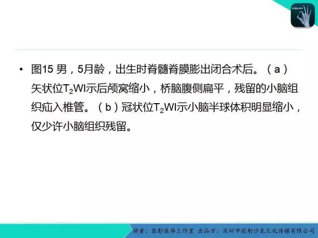 【PPT】后颅窝异常的神经影像学表现