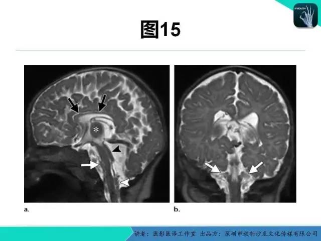 【PPT】后颅窝异常的神经影像学表现