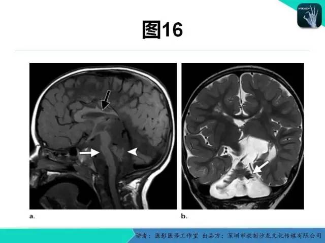 【PPT】后颅窝异常的神经影像学表现