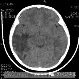 【病例】脑部曼氏裂头蚴病1例MR影像表现 【病例】脑部曼氏裂头蚴病1例MR影像表现