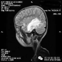 【病例】脑部曼氏裂头蚴病1例MR影像表现 【病例】脑部曼氏裂头蚴病1例MR影像表现