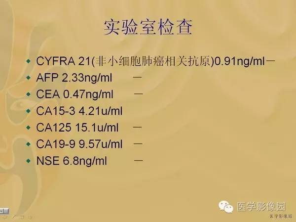 【病例】胃淋巴瘤1例CT影像表现 【病例】胃淋巴瘤1例CT影像表现