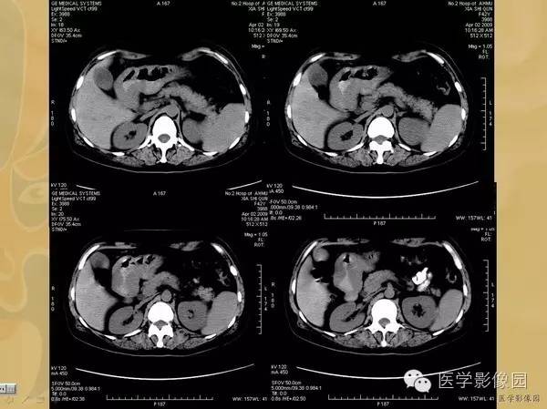 【病例】胃淋巴瘤1例CT影像表现 【病例】胃淋巴瘤1例CT影像表现