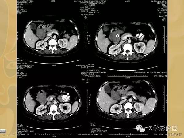 【病例】胃淋巴瘤1例CT影像表现 【病例】胃淋巴瘤1例CT影像表现