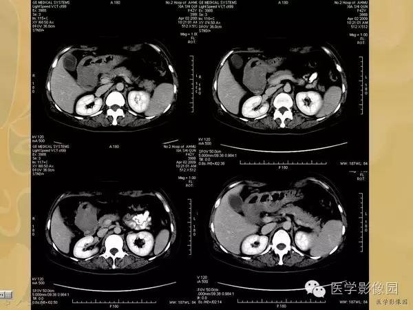 【病例】胃淋巴瘤1例CT影像表现 【病例】胃淋巴瘤1例CT影像表现