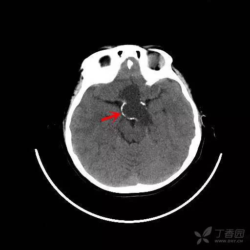 【病例】颅咽管瘤1例CT及MR影像诊断要点