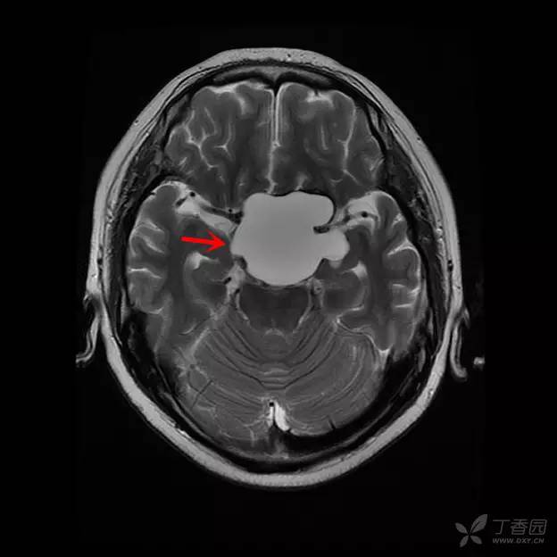 【病例】颅咽管瘤1例CT及MR影像诊断要点 【病例】颅咽管瘤1例CT及MR影像诊断要点