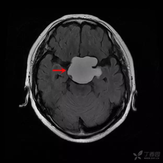 【病例】颅咽管瘤1例CT及MR影像诊断要点 【病例】颅咽管瘤1例CT及MR影像诊断要点