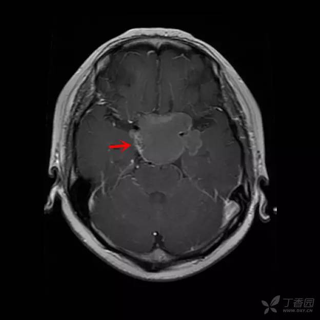 【病例】颅咽管瘤1例CT及MR影像诊断要点 【病例】颅咽管瘤1例CT及MR影像诊断要点
