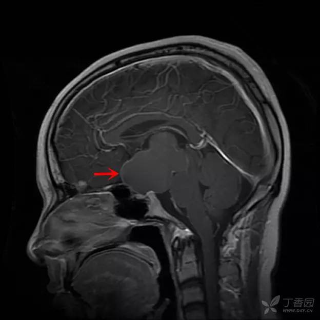 【病例】颅咽管瘤1例CT及MR影像诊断要点 【病例】颅咽管瘤1例CT及MR影像诊断要点