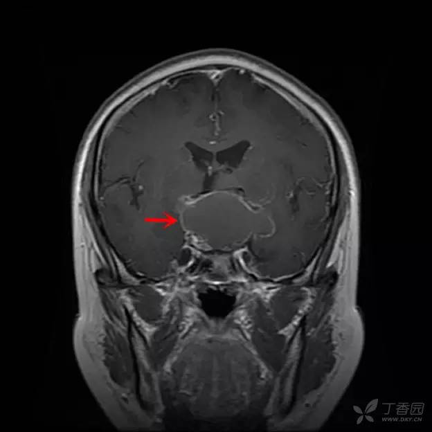 【病例】颅咽管瘤1例CT及MR影像诊断要点 【病例】颅咽管瘤1例CT及MR影像诊断要点