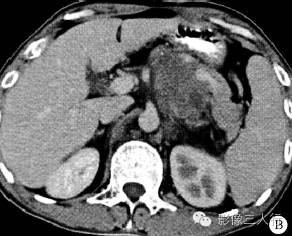【病例】原发性腹腔及腹膜后精原细胞瘤1例CT影像表现 【病例】原发性腹腔及腹膜后精原细胞瘤1例CT影像表现