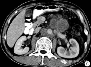 【病例】原发性腹腔及腹膜后精原细胞瘤1例CT影像表现 【病例】原发性腹腔及腹膜后精原细胞瘤1例CT影像表现
