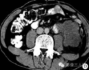 【病例】原发性腹腔及腹膜后精原细胞瘤1例CT影像表现 【病例】原发性腹腔及腹膜后精原细胞瘤1例CT影像表现