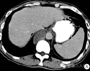 【病例】原发性腹腔及腹膜后精原细胞瘤1例CT影像表现