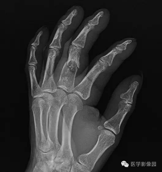 【病例】指骨内生性软骨瘤1例X线及CT影像表现