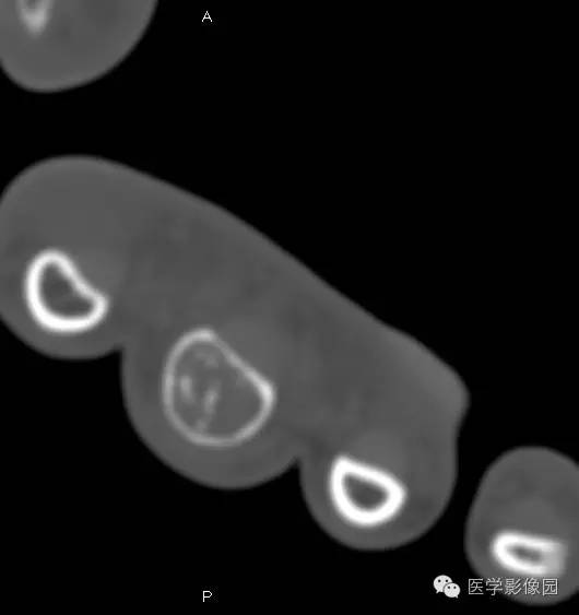 【病例】指骨内生性软骨瘤1例X线及CT影像表现